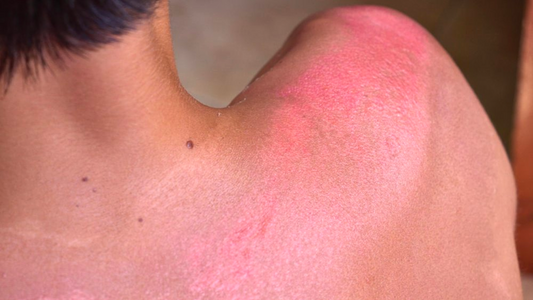 Understanding Sun Poisoning: Causes, Symptoms, and Prevention