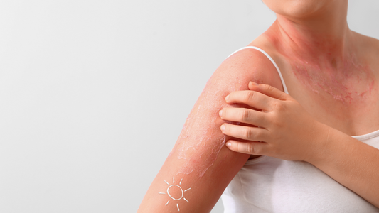 The Hidden Dangers of Relying Solely on Topical Sunscreen for Sun Protection